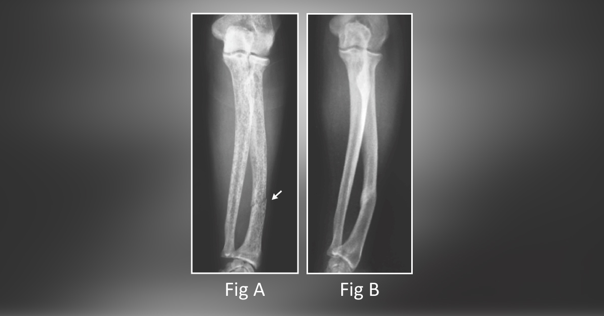 A Rare Case of Radial Fracture