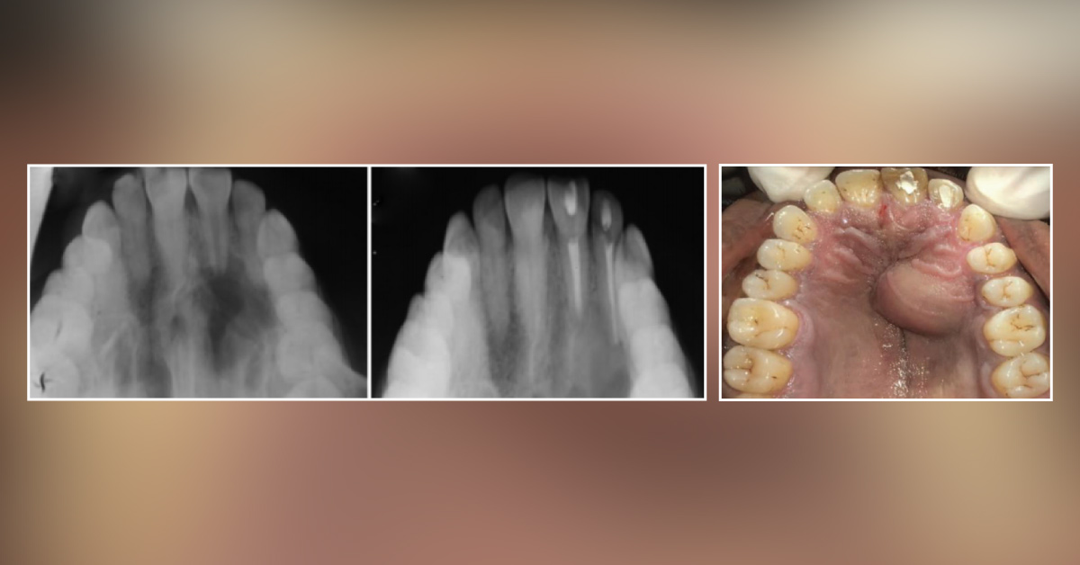 Asymptomatic Palatal Swelling: What can be the Diagnosis?