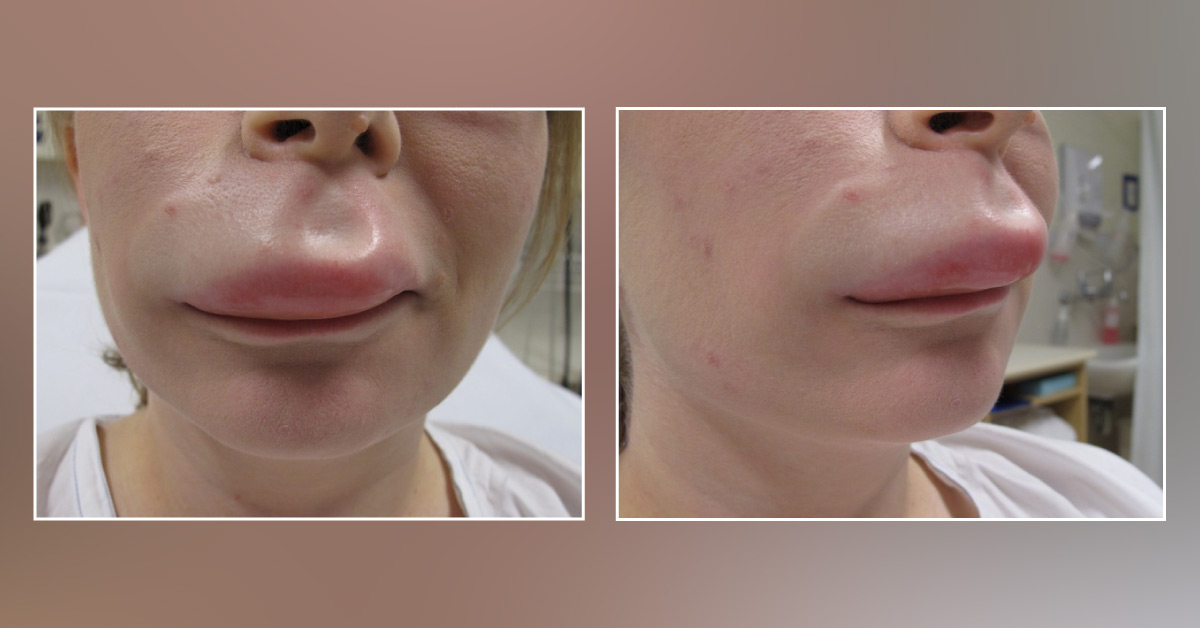Diagnose This Lip Swelling in a Woman