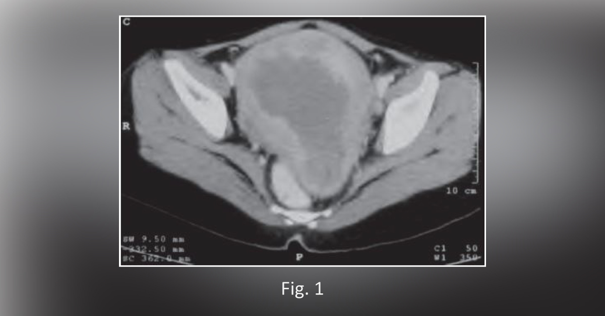 Diagnose the Rare Cause of Abnormal Uterine Bleeding in This Young Woman
