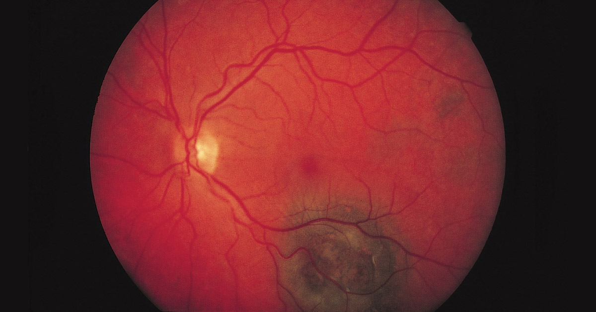 Brief Review On Atypical Manifestations Of Choroidal Melanoma