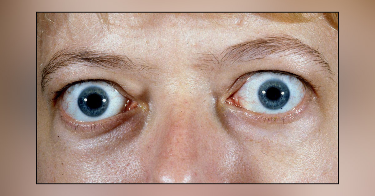 Brief Review On Thyroid Ophthalmopathy