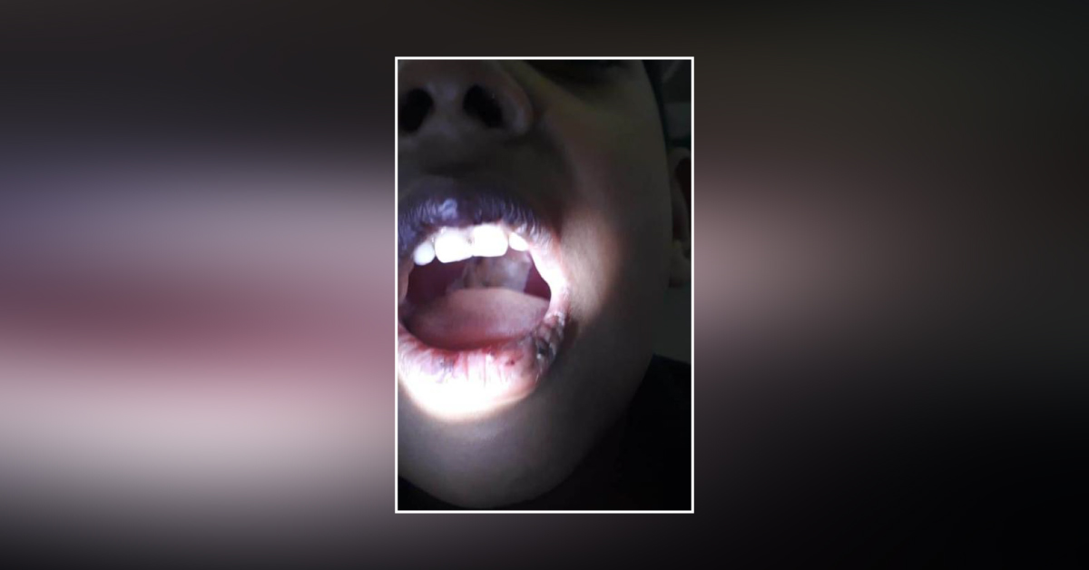 Case Of Diphtheria