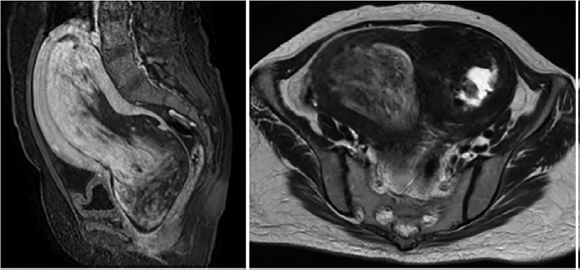 An Interesting Case of a Uterine Tumor