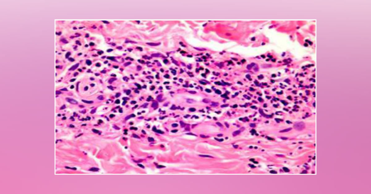 Unusual Incidence of Skin Burns and Spots