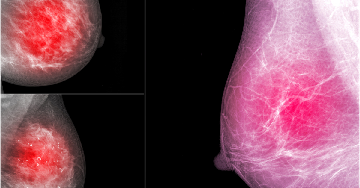 Prediction And Prevention Of Breast Cancer