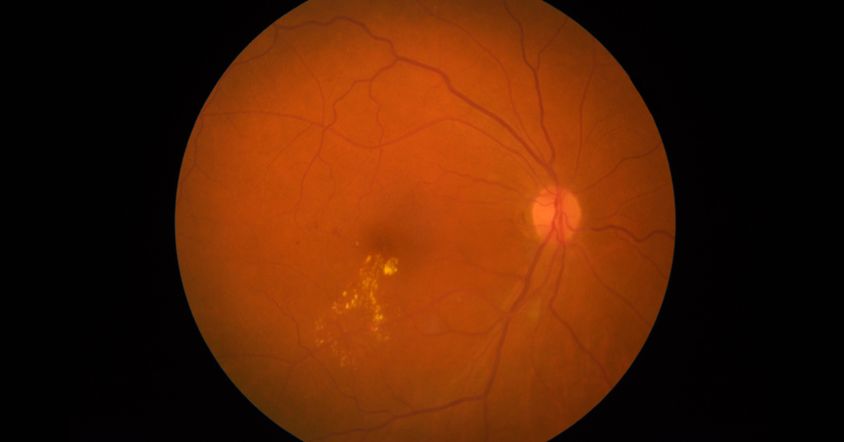 Brief Review On Meibomian Gland Dysfunction