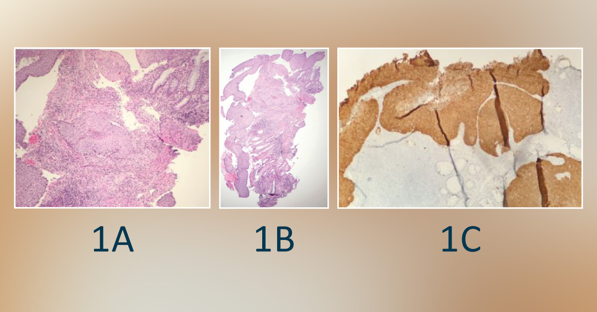 Case of a Woman with a Rare Cause of Rectal Bleeding