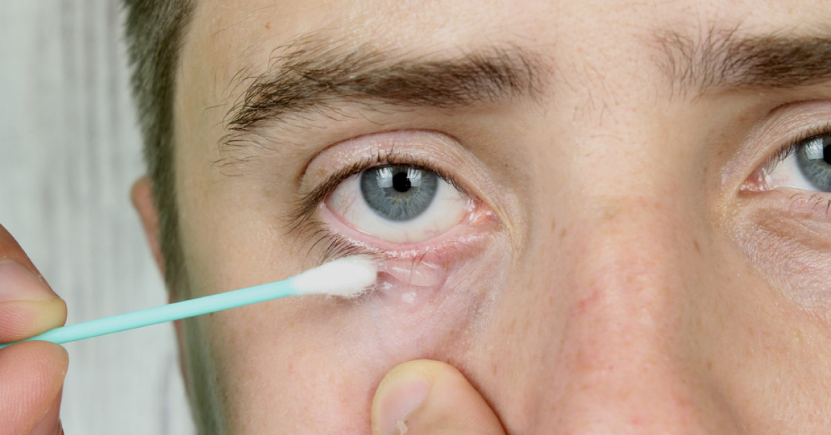 Encountering Ocular Parasites