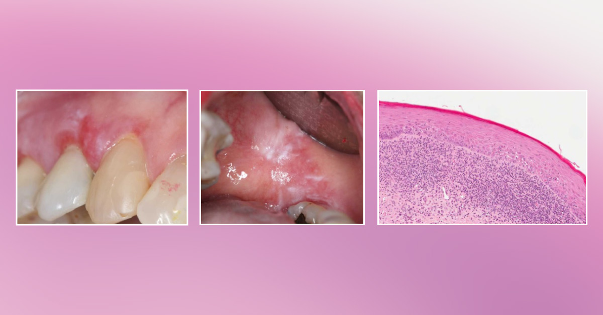 Bleeding Gum in an Aged Woman