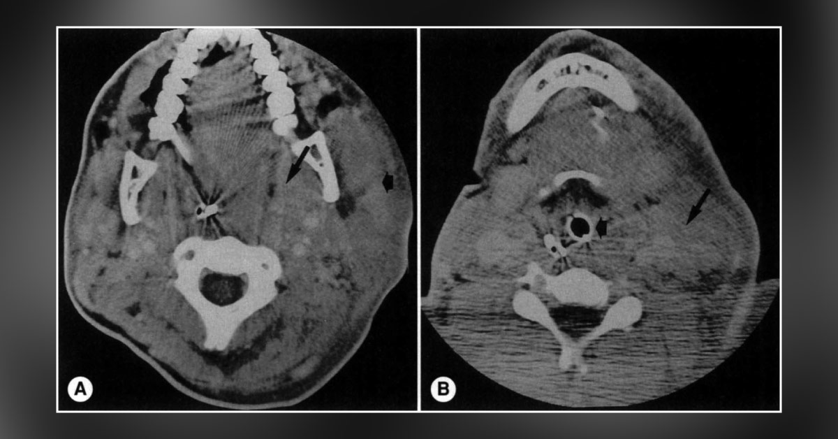 Diagnose This Patient's Condition on the Basis of CT Scan
