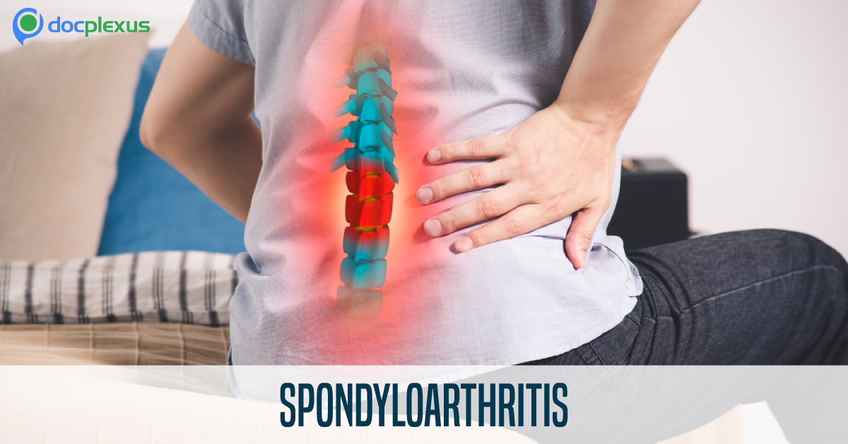 Spondyloarthritis: Diagnosis and Management in Adults