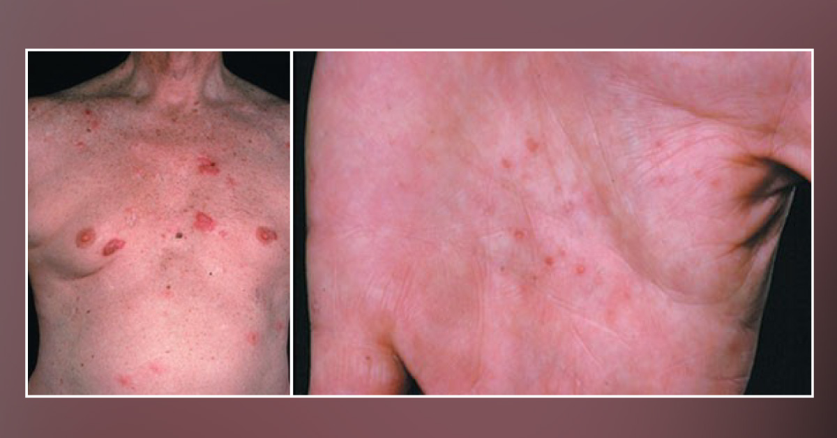 A Patient with Multiple Basal Cell Carcinoma - Identify the Syndrome