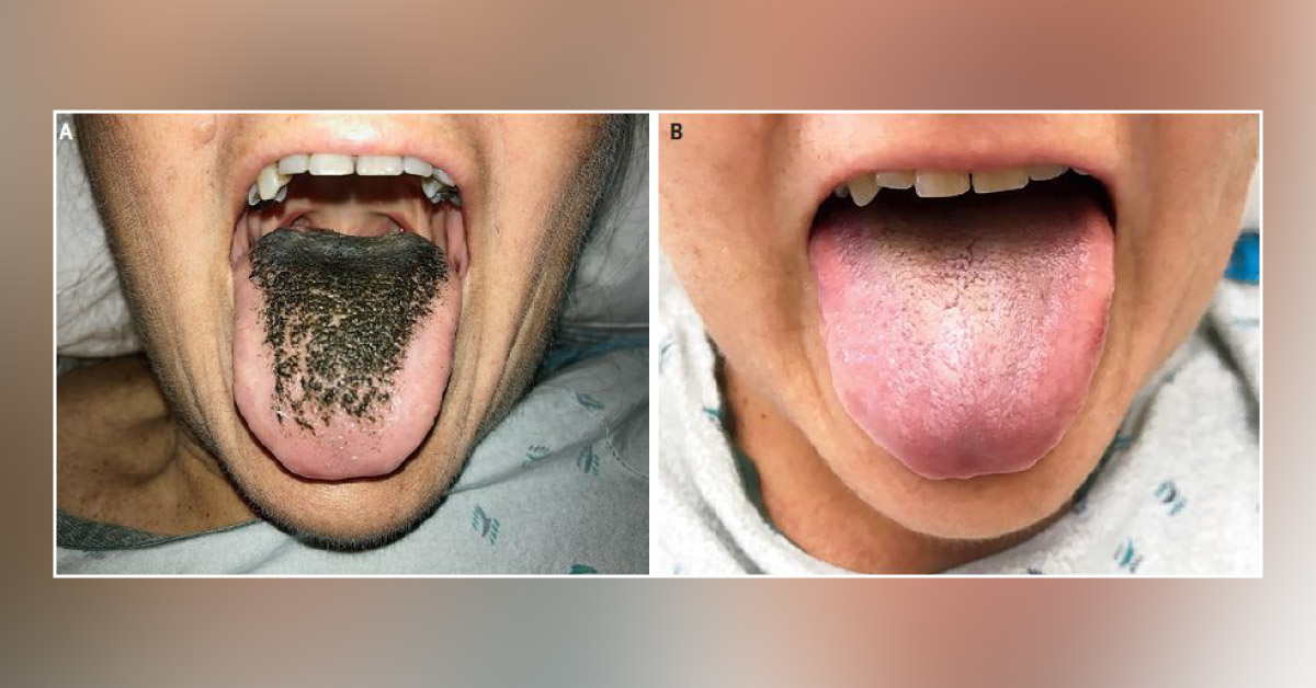 A Case of a Hairy Tongue
