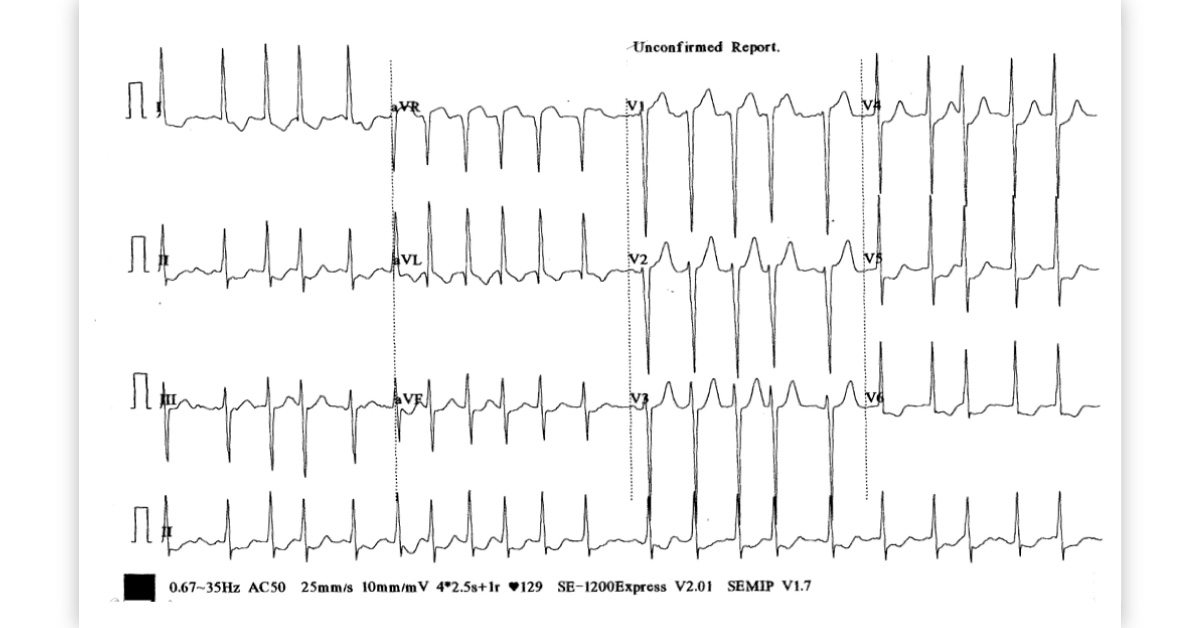 Chest Pain with Abnormal ECG
