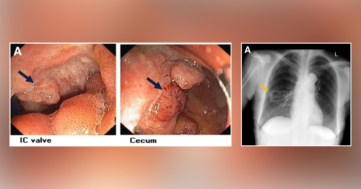 A Rare Complication of Crohn’s Disease: A Case Report