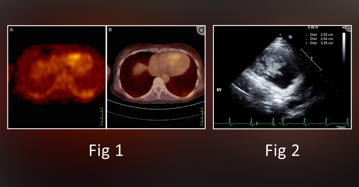 A Case of Vaginal Bleeding and Chest Discomfort