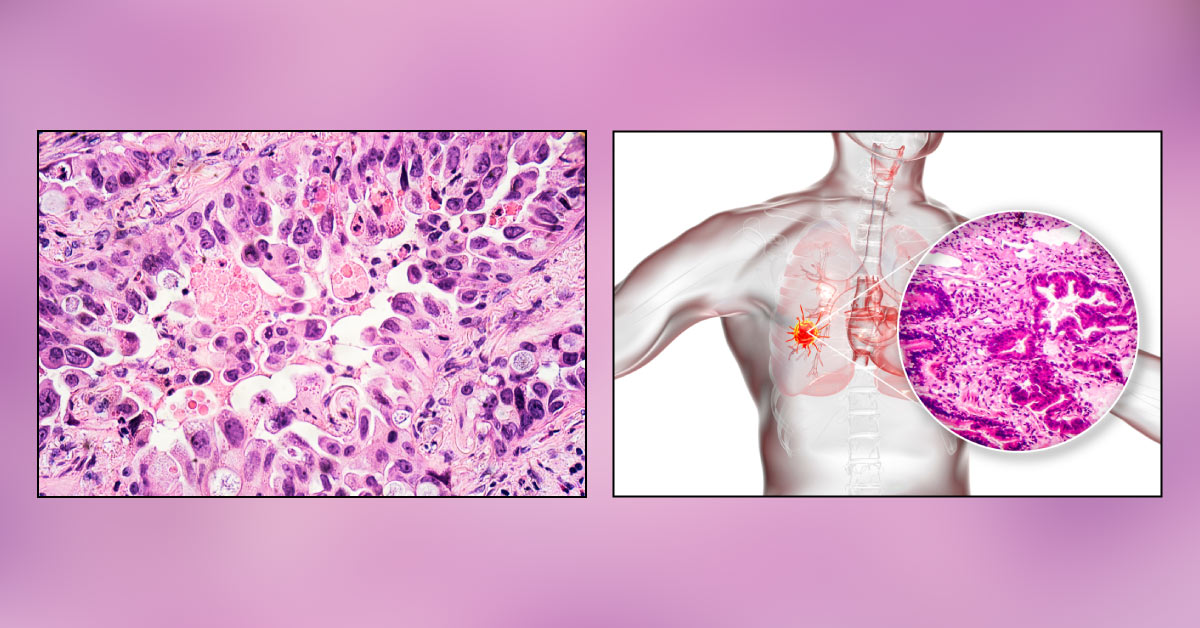 EGFR Mutation In Lung Adenocarcinoma in Indian Subcontinent