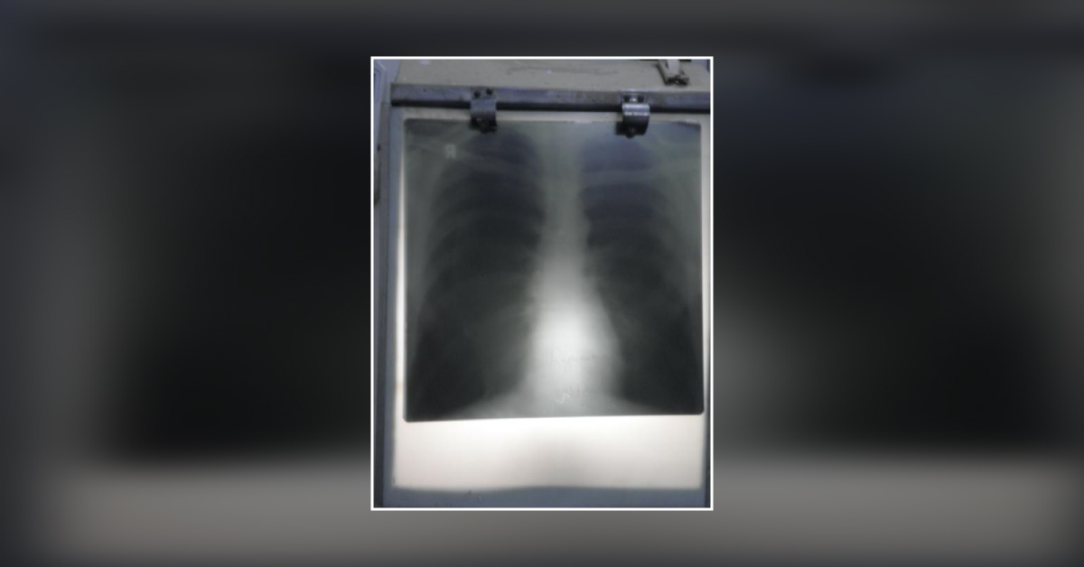 Case Of Right Sided Pneumothorax