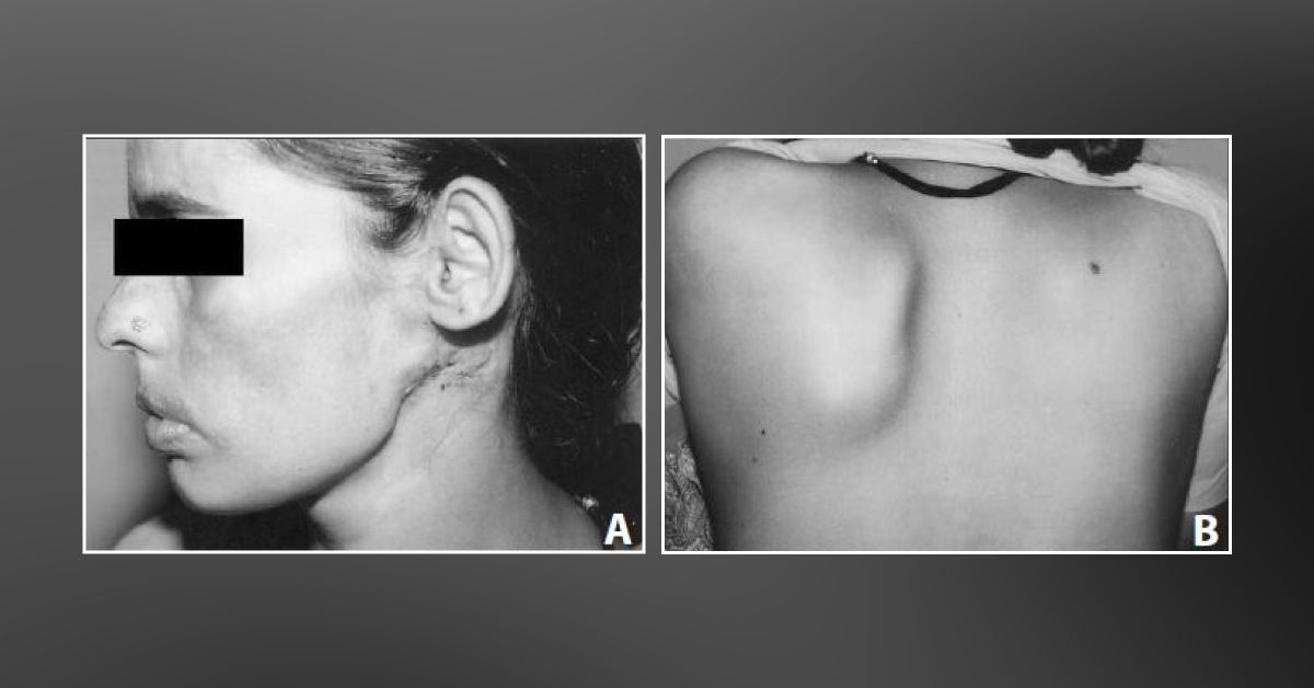 Pleomorphic Adenoma Of The Parotid Gland Metastasizing To The Scapular Region