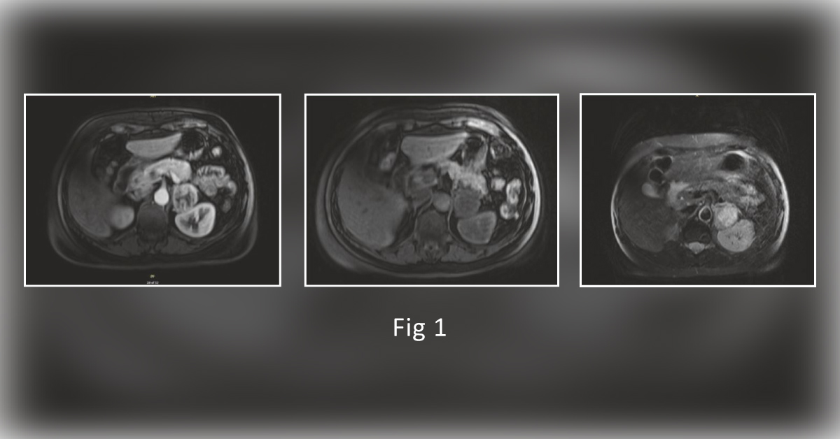 Case of a Woman with Fever of Unknown Origin