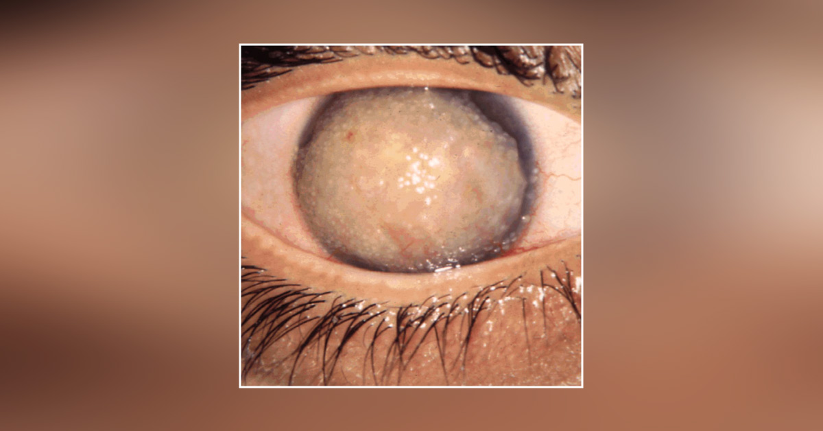 Understanding Congenital Corneal Dystrophy