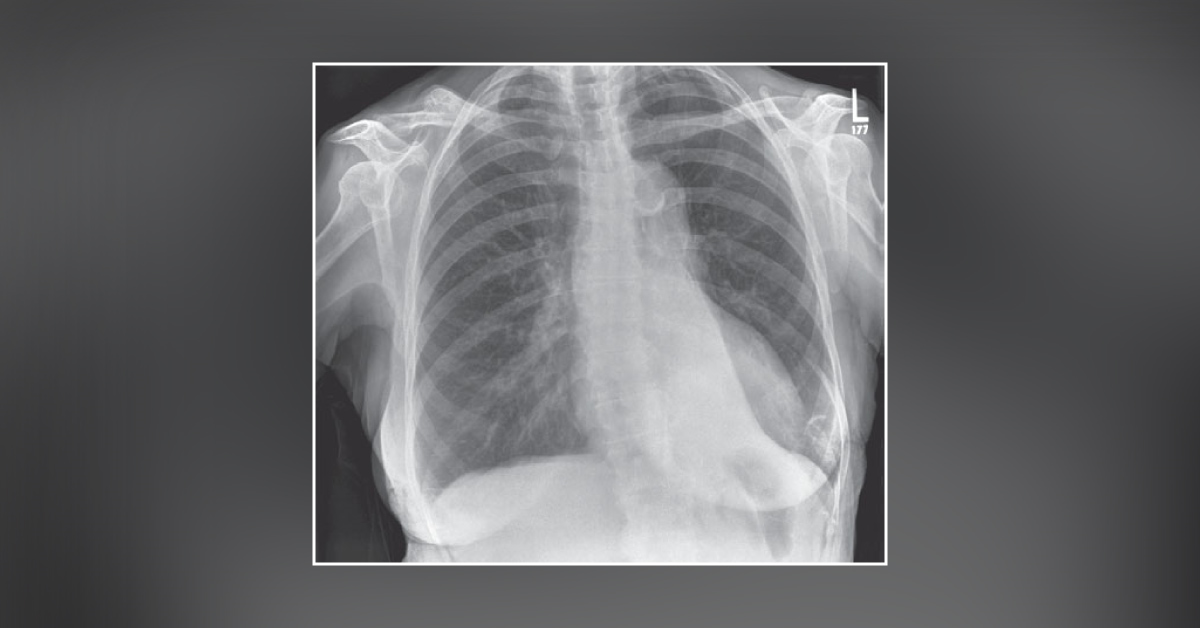 Case of Breathlessness in an Asthmatic Patient