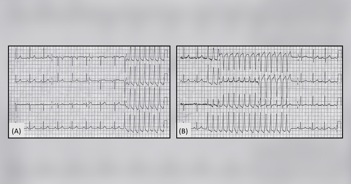 A Woman with Wide Complex Tachycardia and Syncope