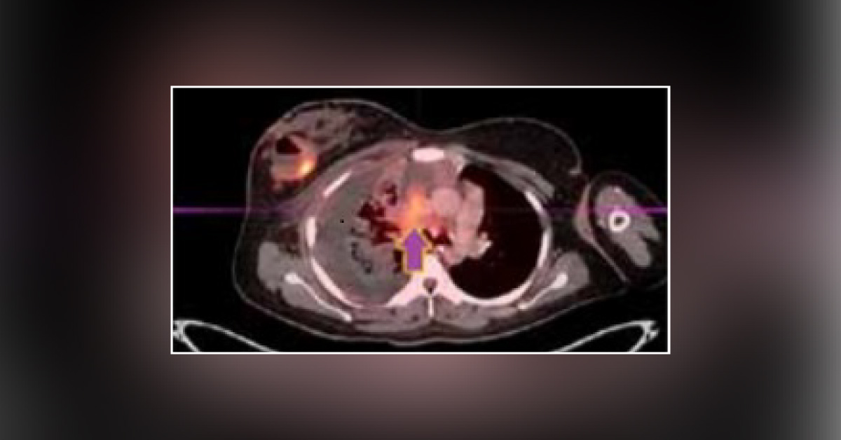 Case Of Primary Rhabdomyosarcoma Of Breast