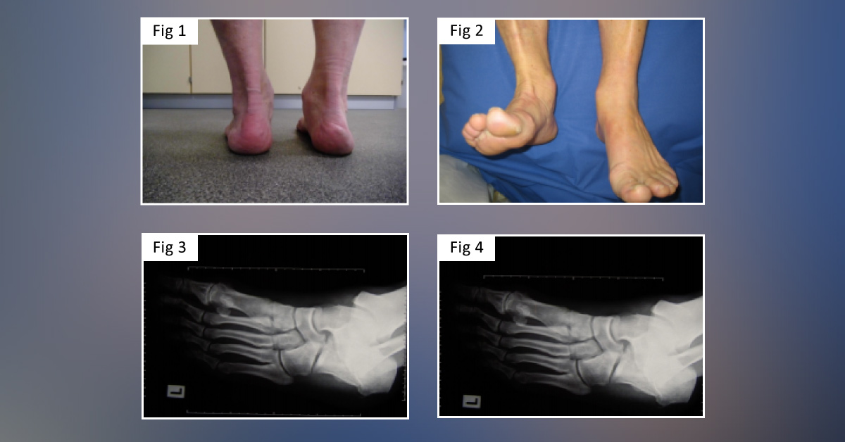 Tendon Rupture in an Athlete -  What's Your diagnosis?