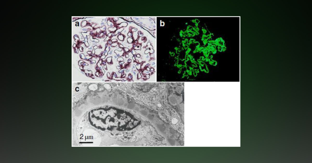 First Reported Case of Liddle’s-like Syndrome