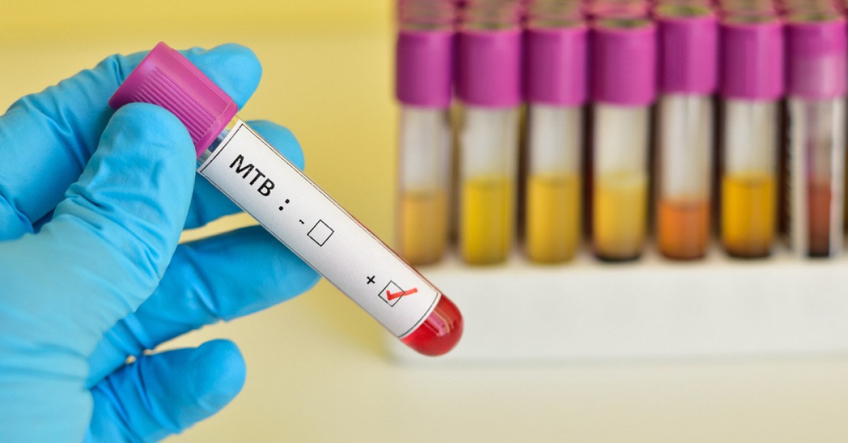 New Blood Tests For TB Could Accelerate Diagnosis And Save The NHS Money