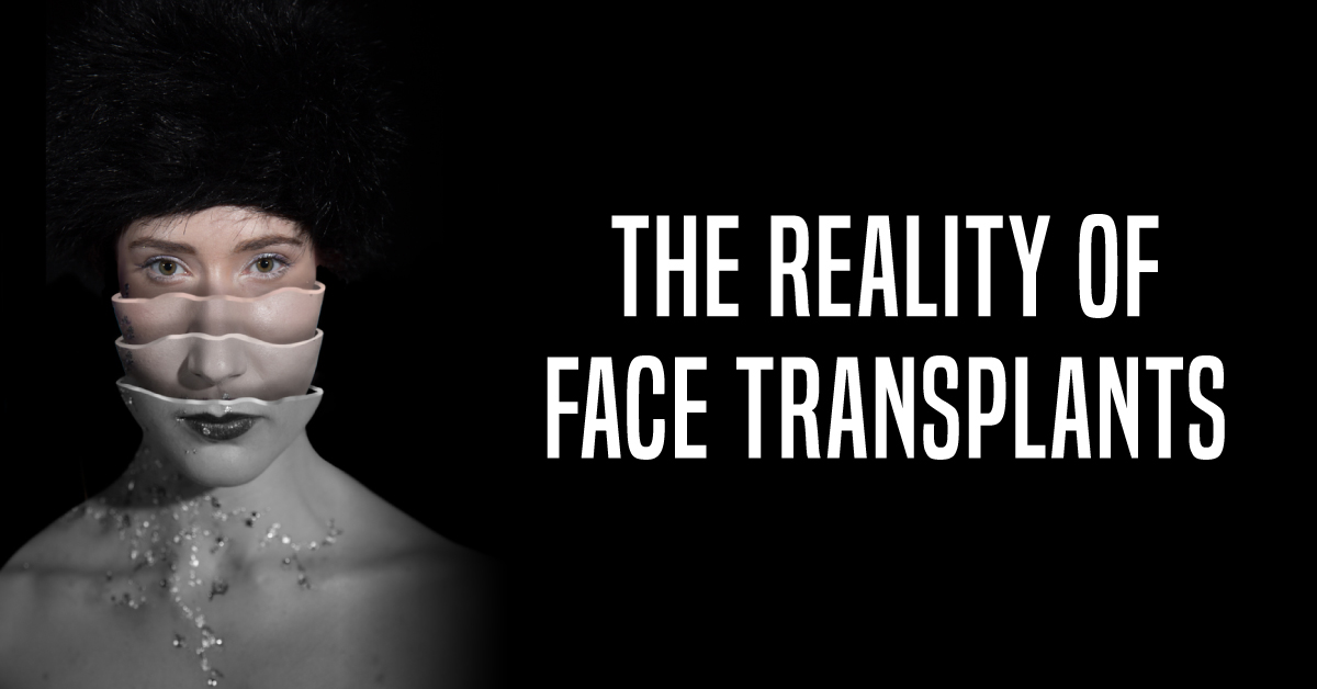 Successful Full Face Transplant