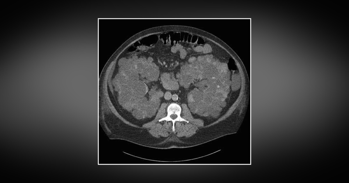 Case of a Man with Macroscopic Hematuria