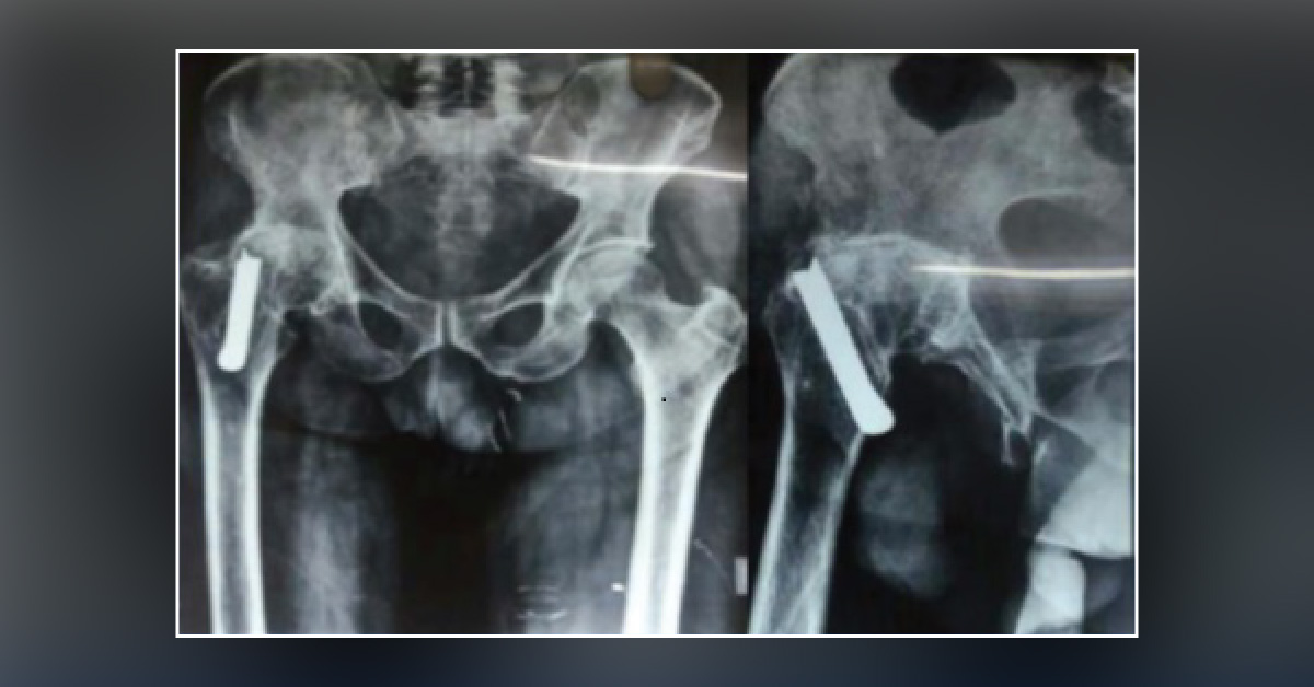 Pain in Right Hip 33 Years After a Road Accident