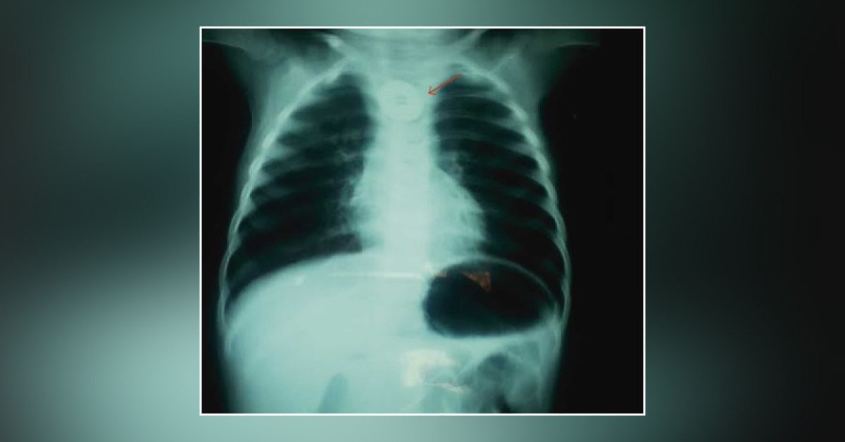Infant with Respiratory Distress: Can You Identify the Cause?