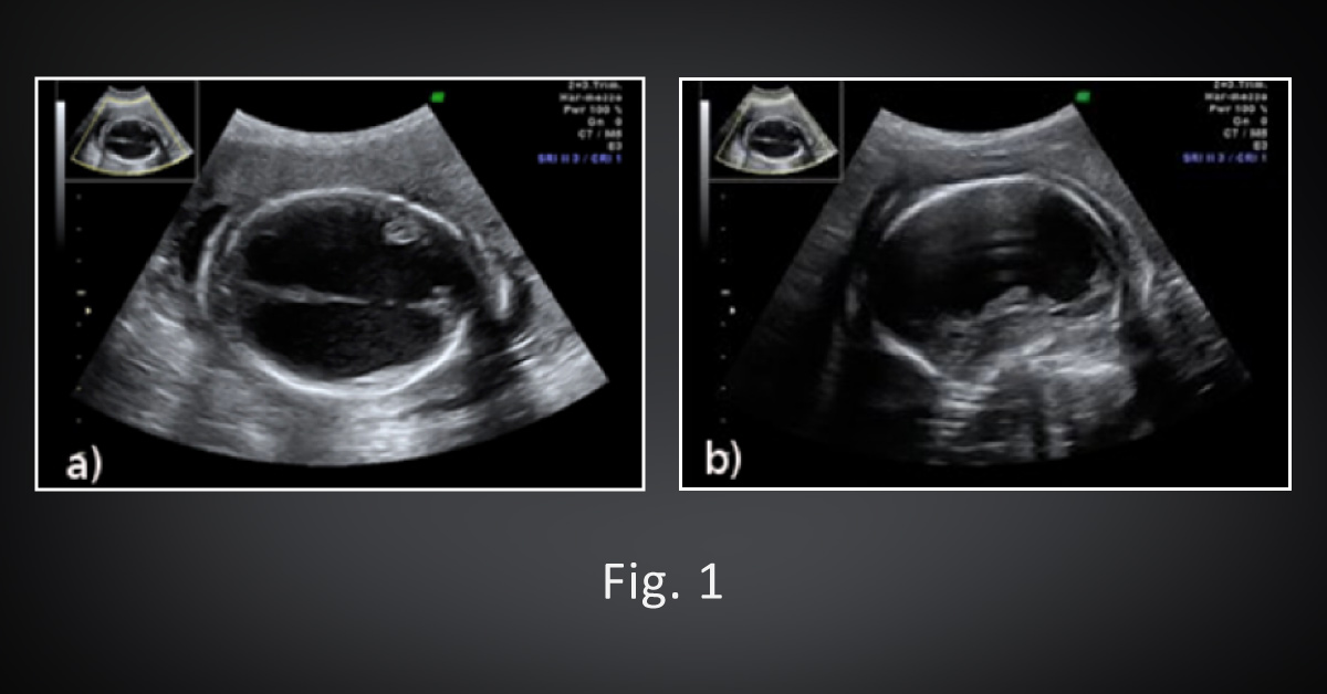 A Case of Syphilis Infection in Pregnancy