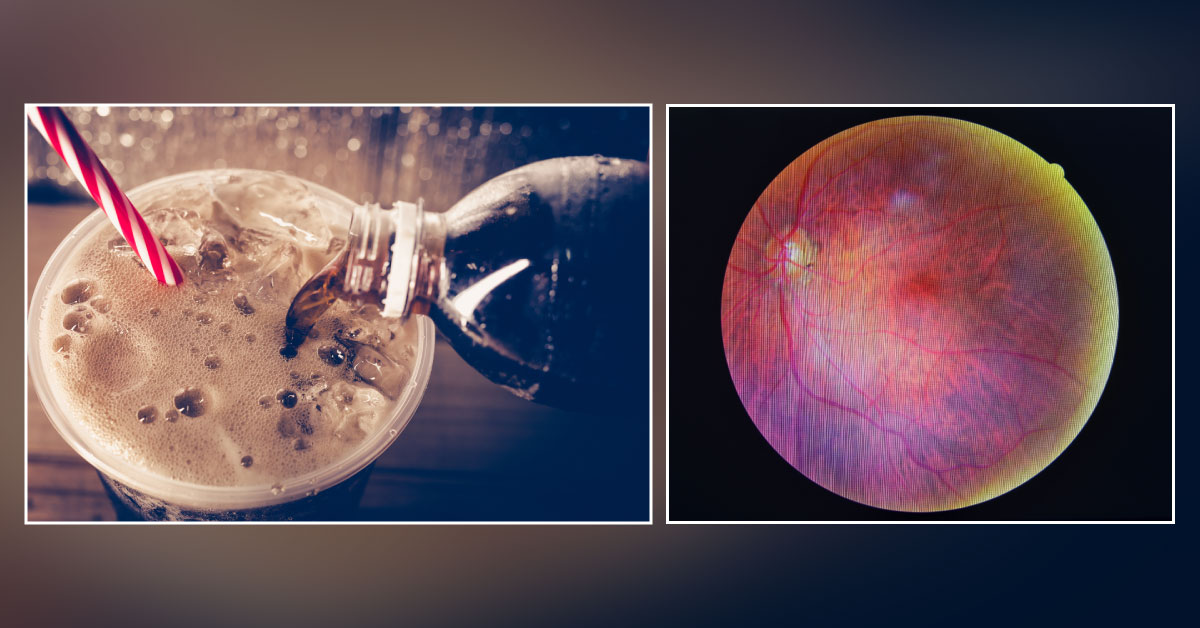 Consumption Of Soft Drinks As Diet Soda Associated With Increased Risk Of Diabetic Retinopathy