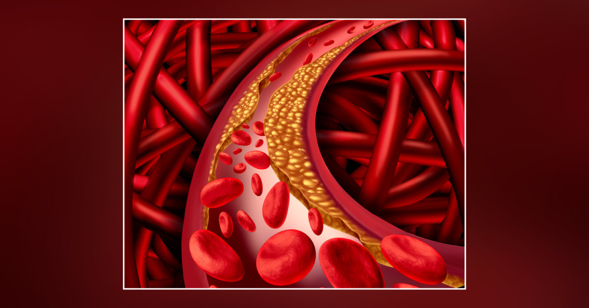 Management Of Plasma Lipid Disorders In The Middle East: Panel To Establish Consensus Clinical Recommendations
