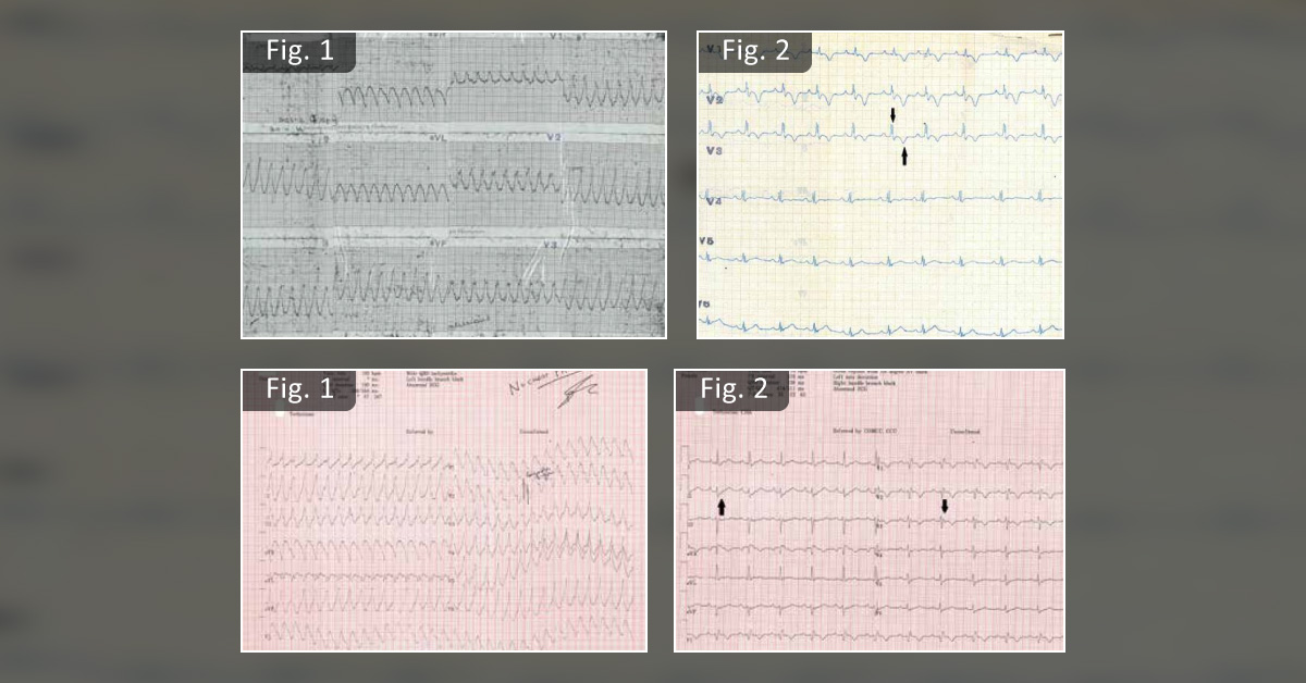 50 years of Ventricular Tachycardia
