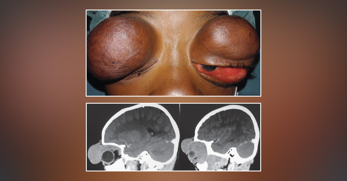 An Unusual Orbital Case Report