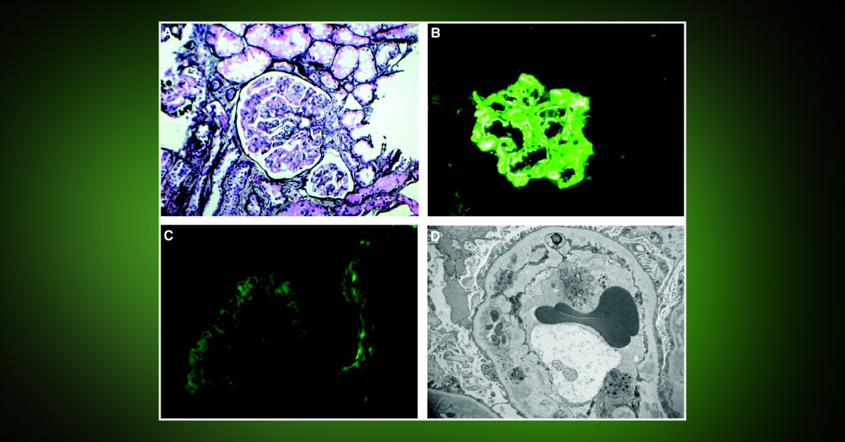 ESRD and Dialysis