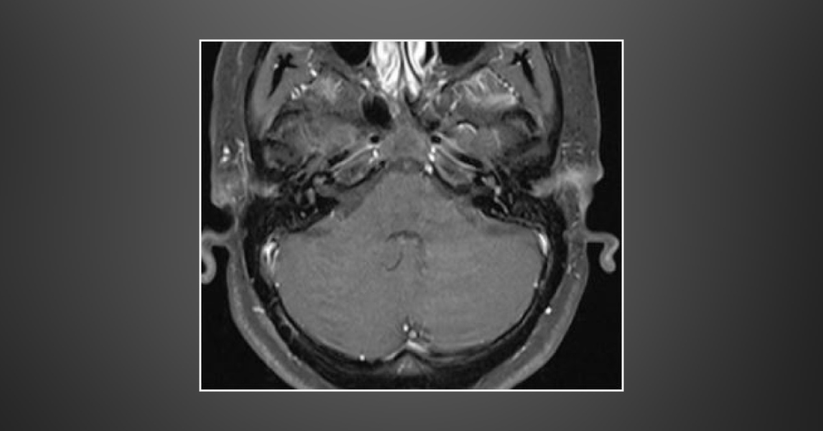 A Case of Sudden Hearing Loss