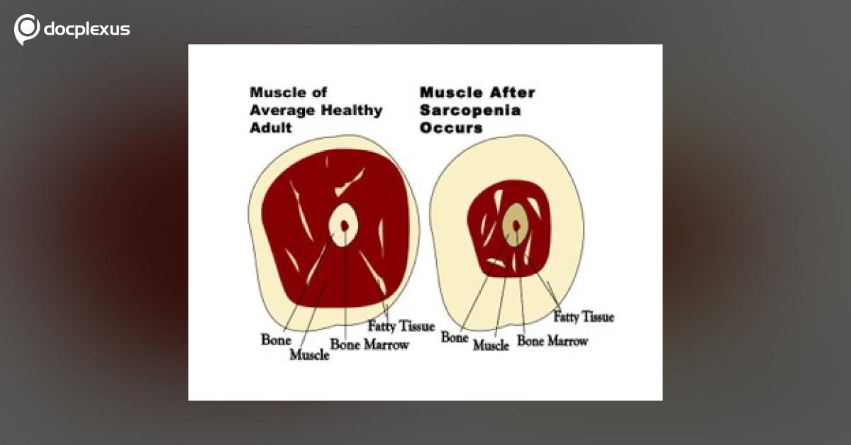 Powdered Nutritional Supplement For Sarcopenia: Community Viewpoint