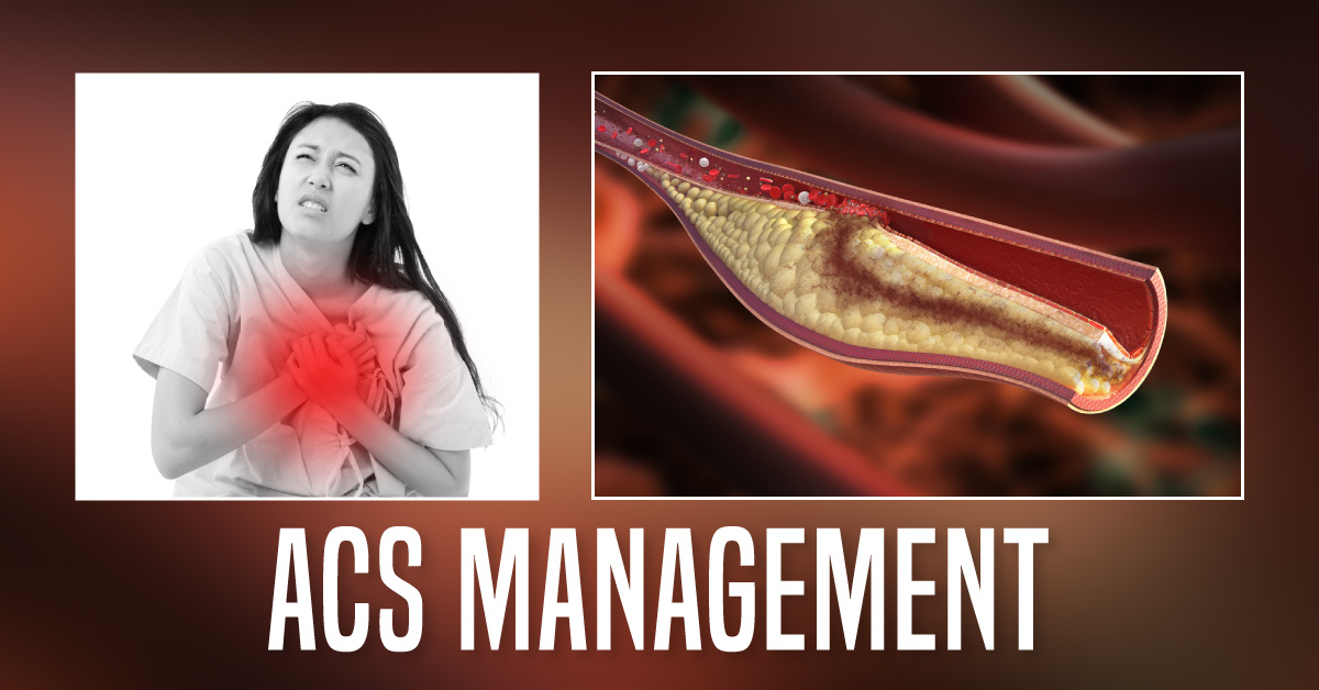 ACS Management: A Physicians  Perspective