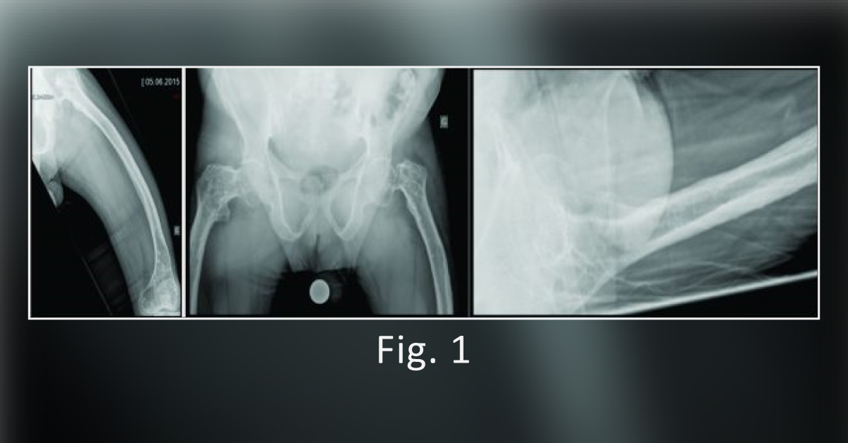 Case of a Patient with Osteogenesis Imperfecta