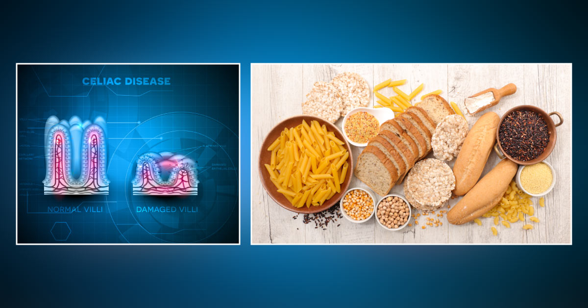Now Gluten Free Diet Will Be Levelled To Better Treat Celiac Disease