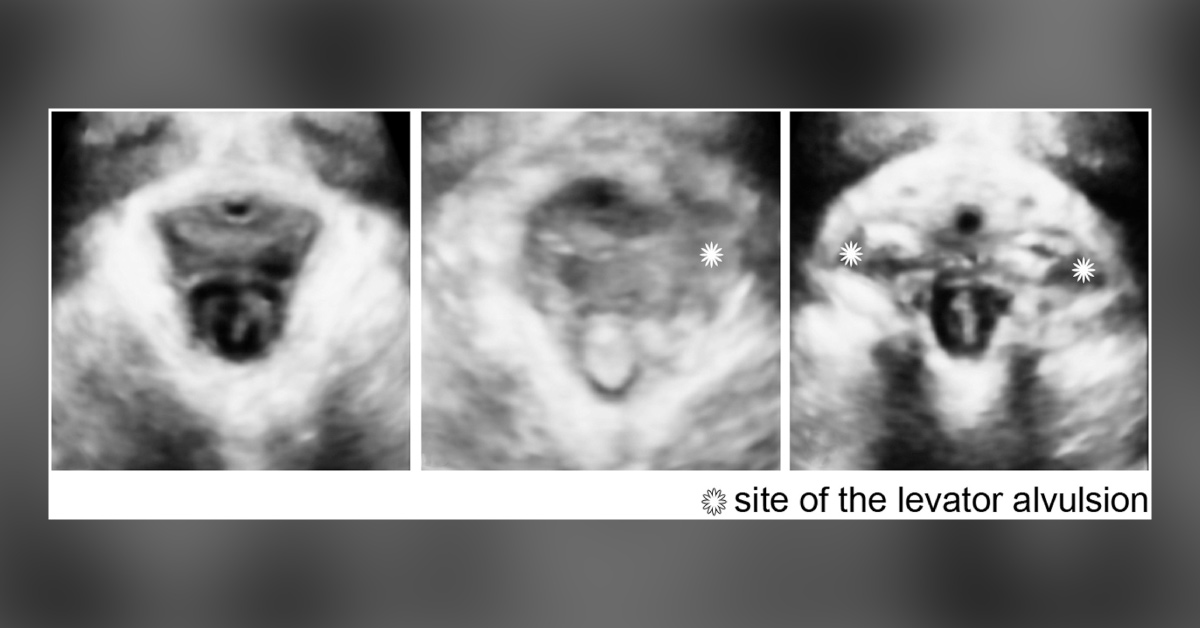 Does Levator Injury Have Any Association With Urogynecological Complaints?