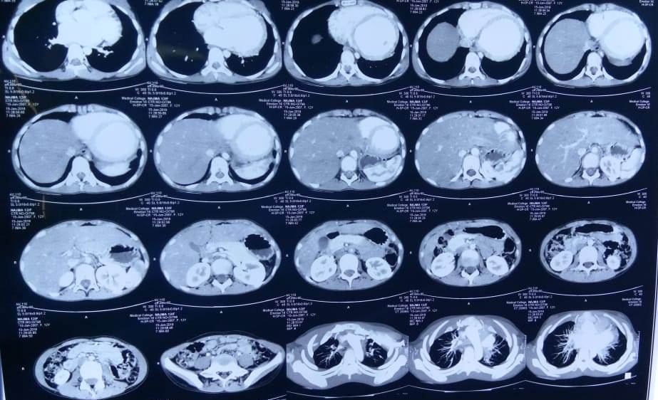 Dyspnoea In An Adolescent Girl