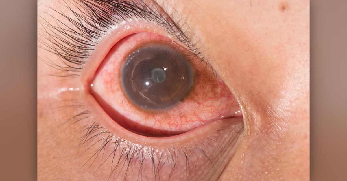 Brief Review On Ocular Manifestations Of Hyperlipidemia